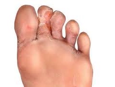 Si el hongo en los pies los síntomas
